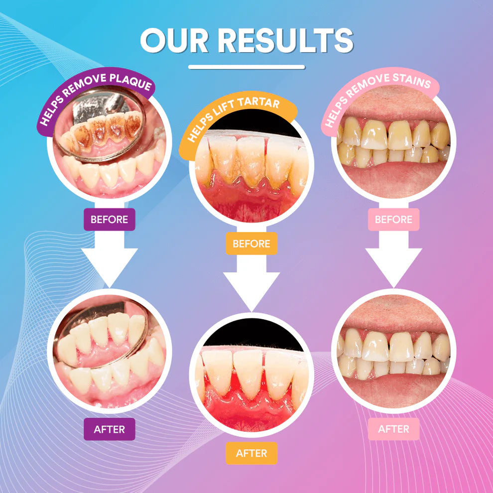 Ultrasonic Tooth Cleaner